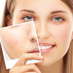 Condition Acne CF 300x300